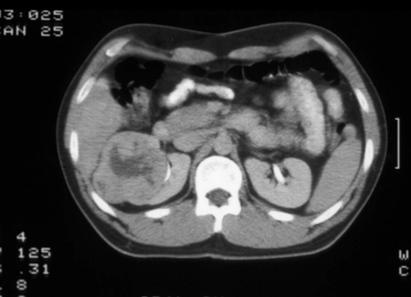 <p>Abdominal CT w/ &amp; w/o contrast plus delayed imaging, urine cytology, renal biopsy required for definitive diagnosis</p>