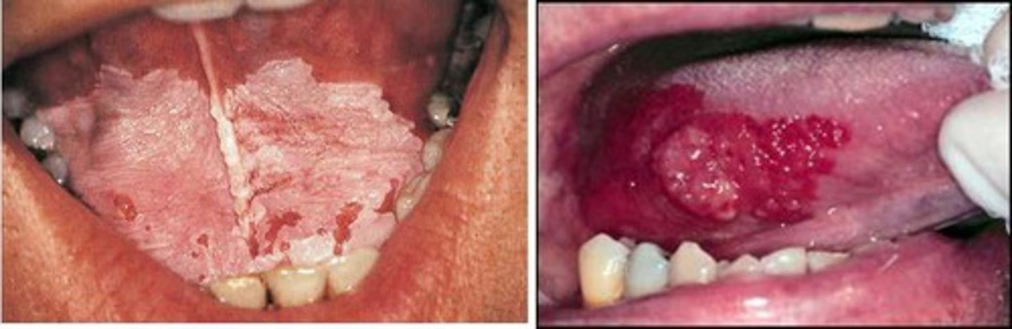 <p>white and red patches on oral mucosa</p><p>- precursor to cancer</p>