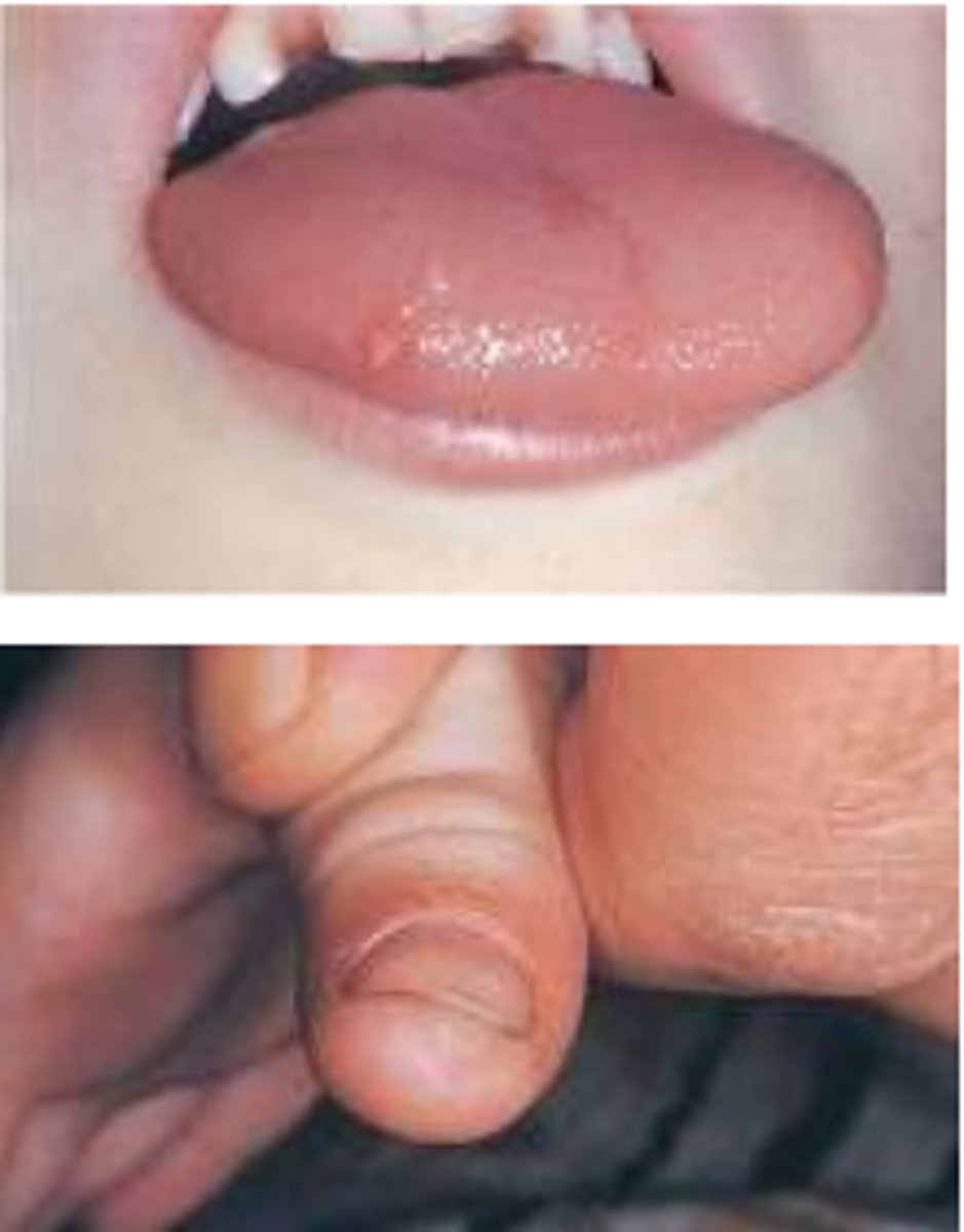 <p>White, papillary exophytic lesion resembling a papilloma</p>