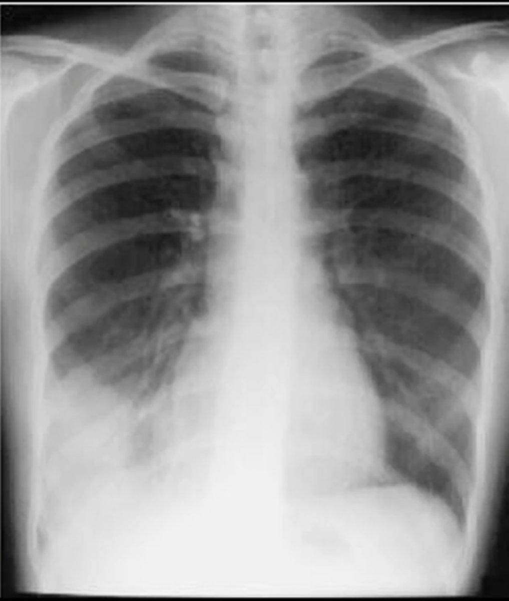 <p>air bronchiolgrams and near the diaphragm on the left bottom (RLL of patient)</p>