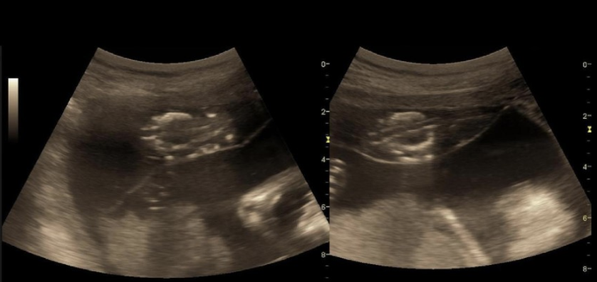 <p>a monochorionic diamniotic twin pregnancy shows 2 female fetuses w/normal fetal heart rates. fetus A is 25% larger than fetus B. fetus A haspolyhydramnios. fetus B has oligohydramnios</p><p>a) vanishing twin syndrome</p><p>b) molar twin pregnancy</p><p>c) twin reversed arterial perfusion sequence</p><p>d) twin to twin transfusion</p>