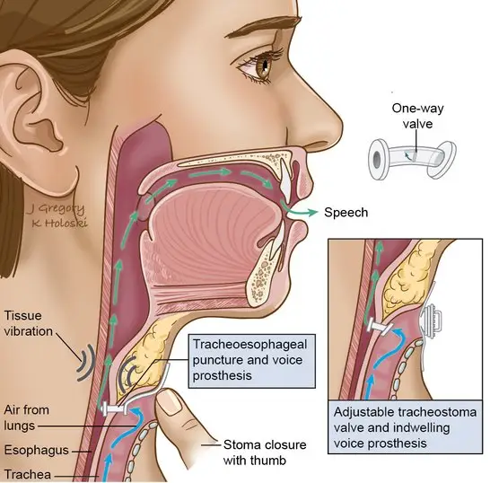 <p>connects trachea to esophagus with a plastic valve</p><p>(enhanced burp talk)</p><p></p>