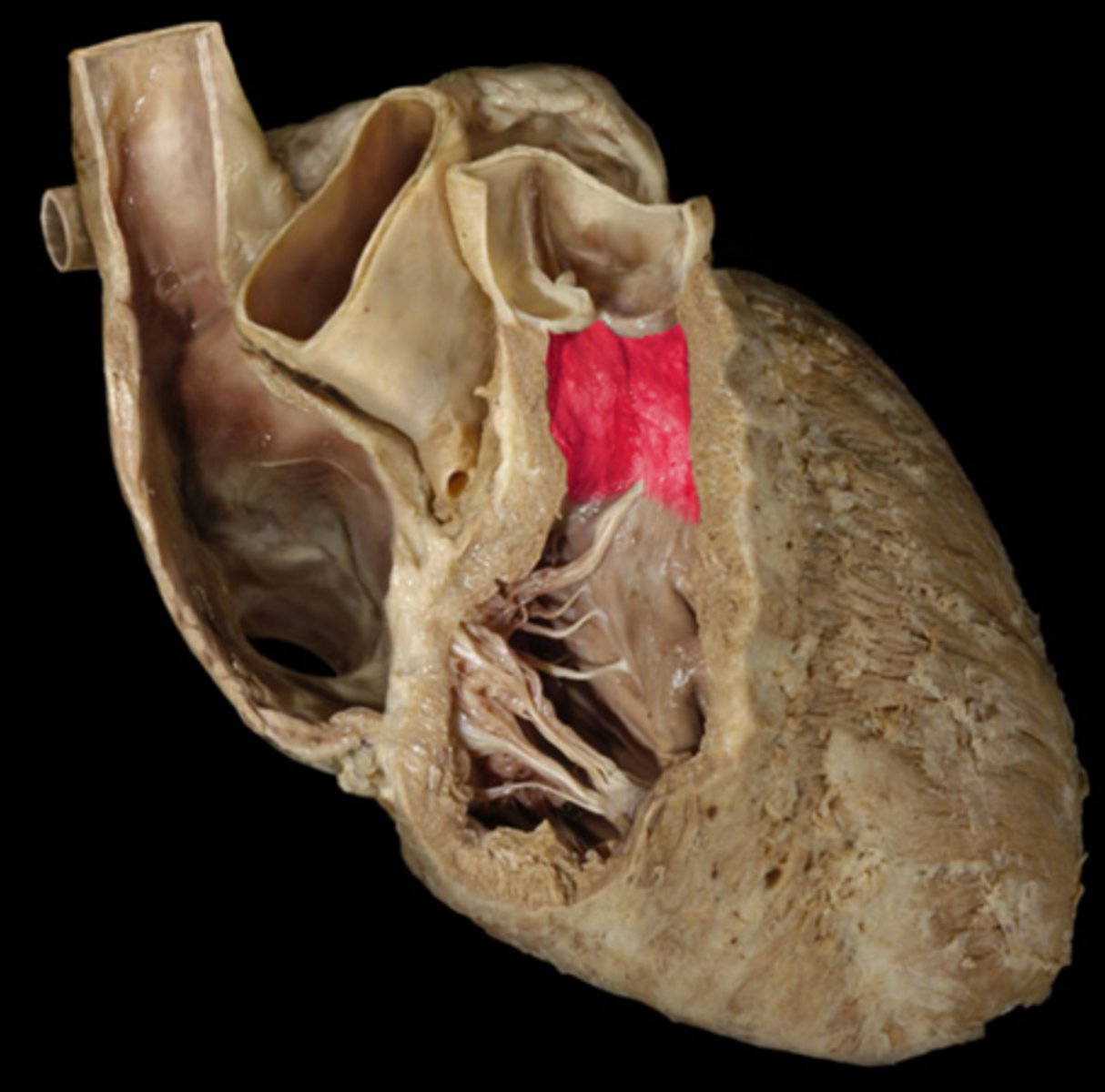 <p>cone-shaped part of the ventricles that leads into the pulmonary trunk (narrowing)</p>