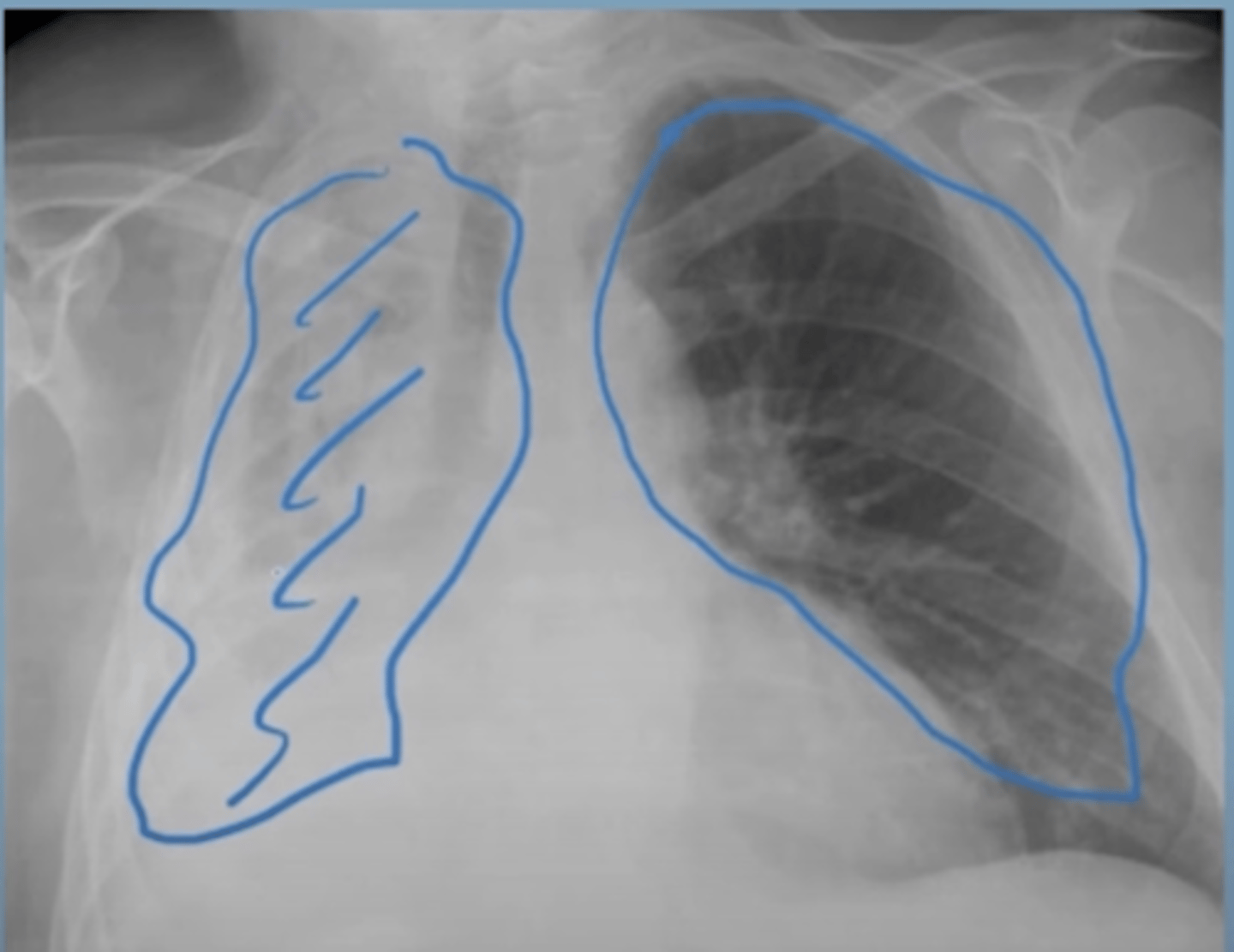 <p>Right lung: All alveoli are full of air which shows black on an x-ray.</p><p>Left lung: All alveoli are collapsed and don’t have air in them, showing white on x-ray</p>