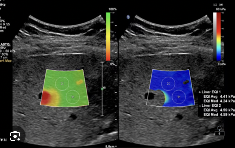 <p><strong>What is elastography in ultrasound, and how is it used to assess tissue stiffness?</strong></p>