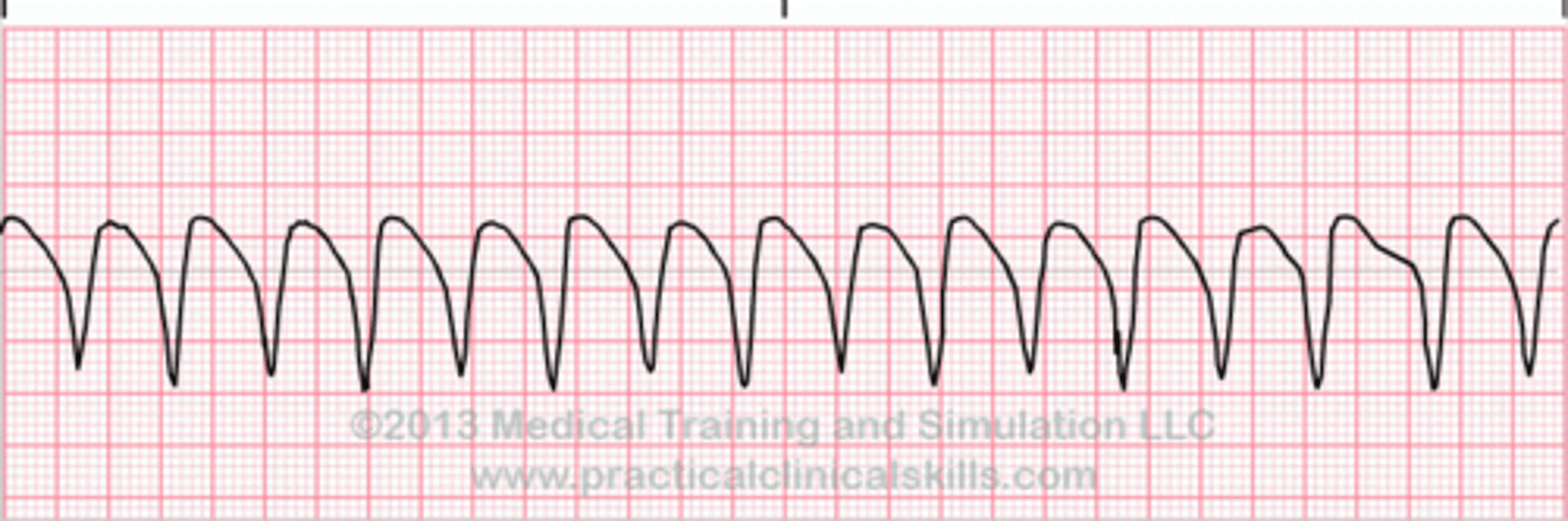 <p>wide complex tachycardia</p>
