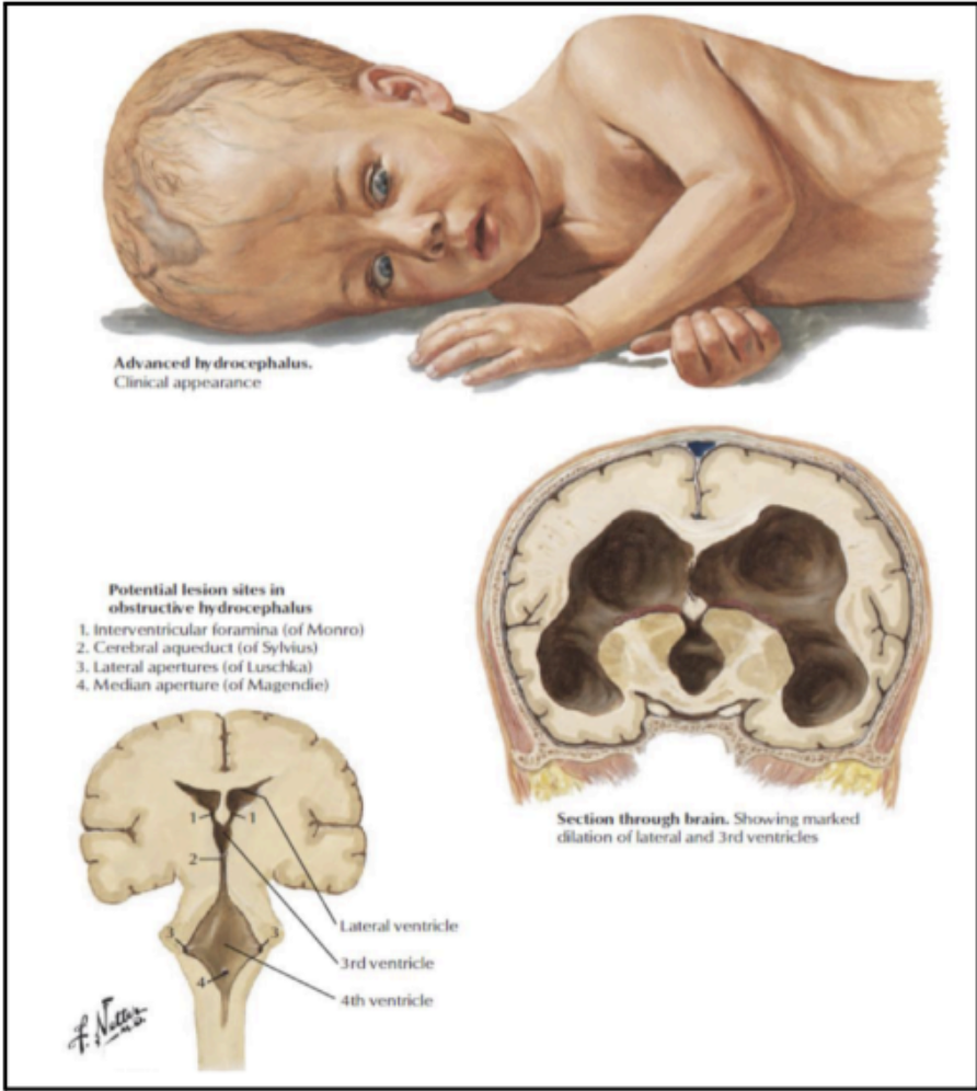<p>Communicating Hydrocephalus</p>