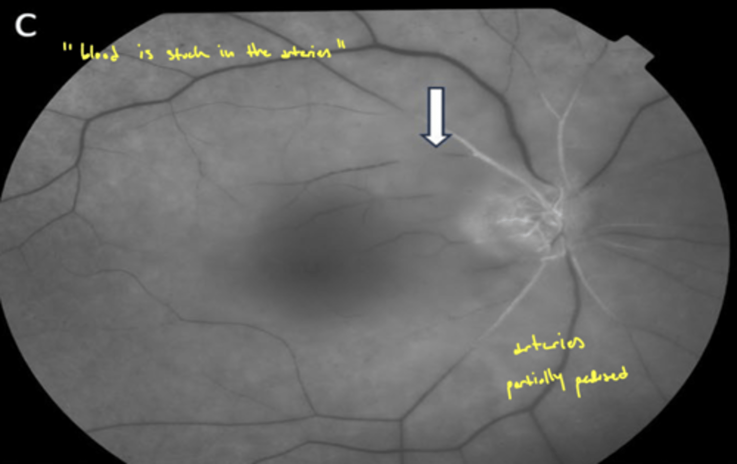 <p>"blood is stuck in arteries"</p>