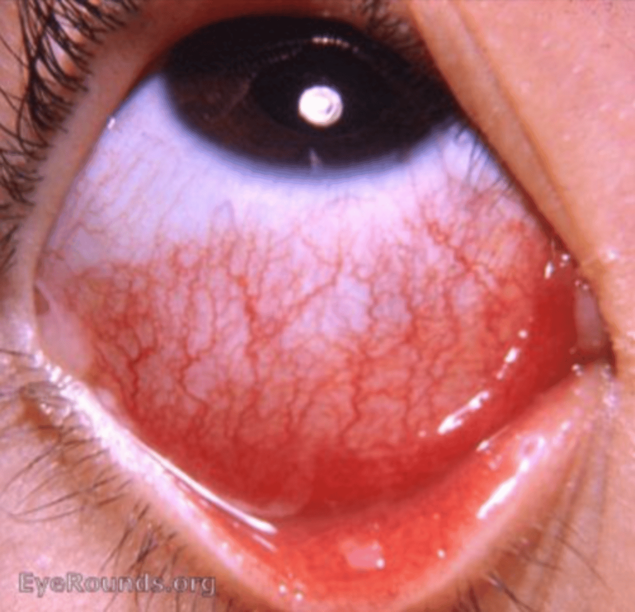 <p>What do we call the transition of white eye to red eye in bacterial conjunctivitis?</p>