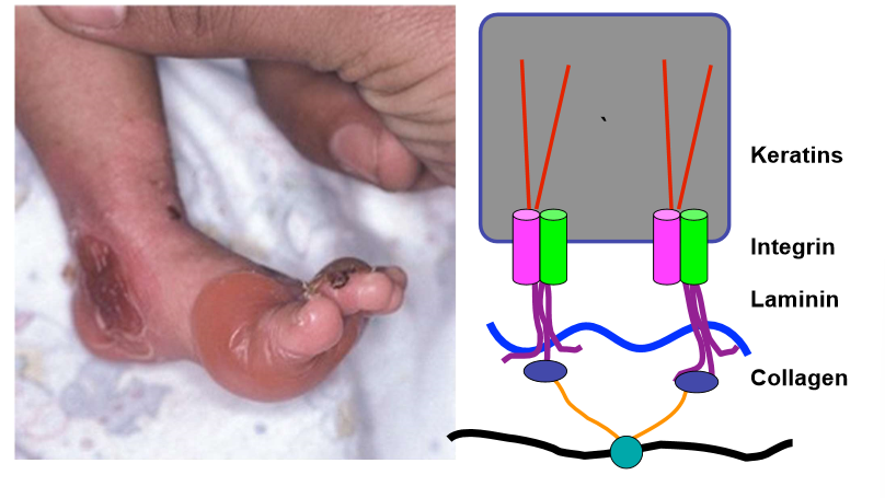 <ul><li><p>usually restricted to blisters on regions subject to mechanical stress </p></li><li><p>can deal without significant scarring </p></li><li><p>compare with JEB, has 40% mortality in first year</p></li><li><p>mostly associated with mutations in keratin 5 and 14 </p></li></ul><p></p>