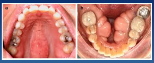 <p>tori: hard palate midline or lingual mandible </p>