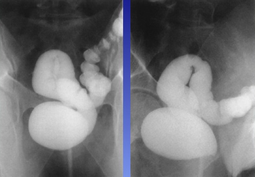 <p>What is this x-ray demonstrating?</p>