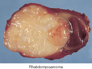 <p><span><span>Identify the pathology definition for the following illustration.</span></span><br></p>