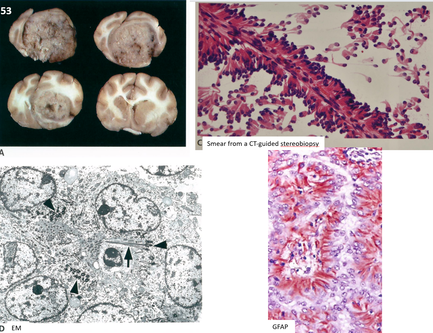 <p>53. Tissue from a cat. What is the morphologic diagnosis?</p><p class="MsoListParagraphCxSpFirst"><span>a.</span><span style="font-size: 7pt; font-family: &quot;Times New Roman&quot;">&nbsp;&nbsp;&nbsp;&nbsp; </span>Choroid plexus tumor</p><p class="MsoListParagraphCxSpMiddle"><span>b.</span><span style="font-size: 7pt; font-family: &quot;Times New Roman&quot;">&nbsp;&nbsp;&nbsp;&nbsp; </span>Meningioma</p><p class="MsoListParagraphCxSpMiddle"><span>c.</span><span style="font-size: 7pt; font-family: &quot;Times New Roman&quot;">&nbsp;&nbsp;&nbsp;&nbsp; </span><span>Ependymoma</span></p><p class="MsoListParagraphCxSpMiddle"><span>d.</span><span style="font-size: 7pt; font-family: &quot;Times New Roman&quot;">&nbsp;&nbsp;&nbsp;&nbsp; </span>Astrocytoma</p><p class="MsoListParagraphCxSpLast"><span>e.</span><span style="font-size: 7pt; font-family: &quot;Times New Roman&quot;">&nbsp;&nbsp;&nbsp;&nbsp; </span>Metastatic carcinoma</p>