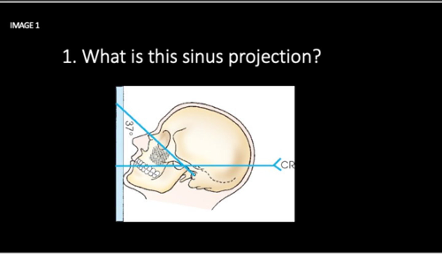 <p>What is this sinus projection?</p>