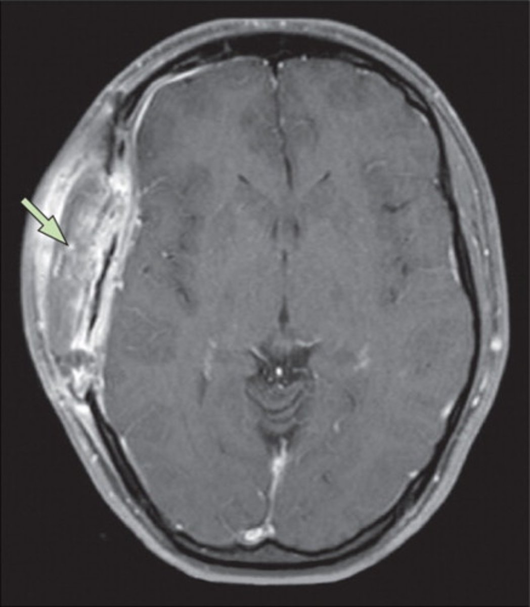 <p>Abscess located outside the dura mater</p><p>- can cause local pain</p>