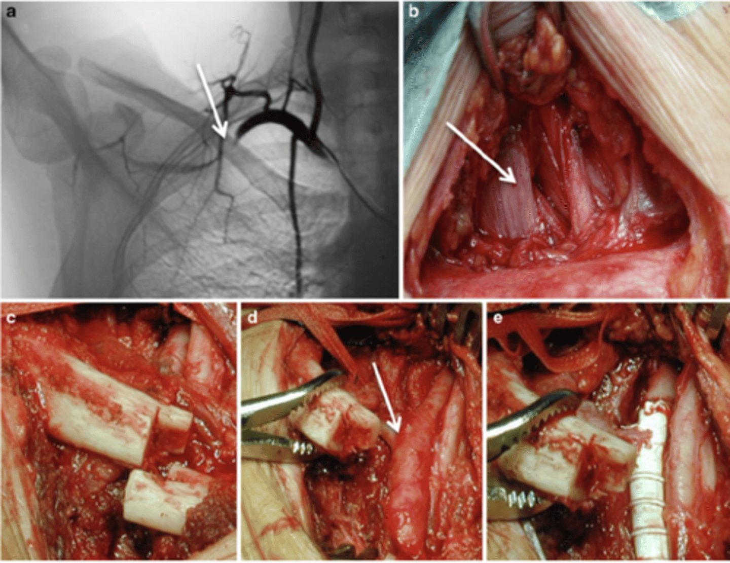 <p>IV heparin, embolectomy, local thrombectomy, endovascular stent placement, or vascular bypass/grafting.</p>