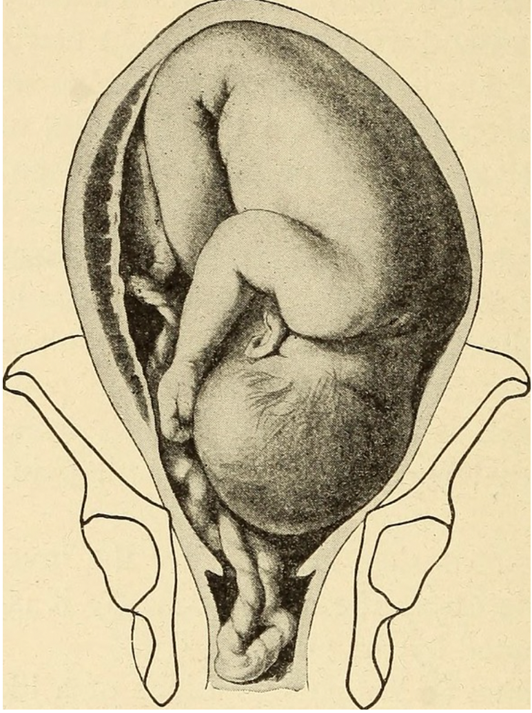 <p>assessing for the presenting parts and lifting the head to reduce compression </p><ul><li><p>umbilical cord prolapse → fetal head compresses the umbilical cord preventing BF to the fetus causing decelerations  </p></li></ul><p></p>