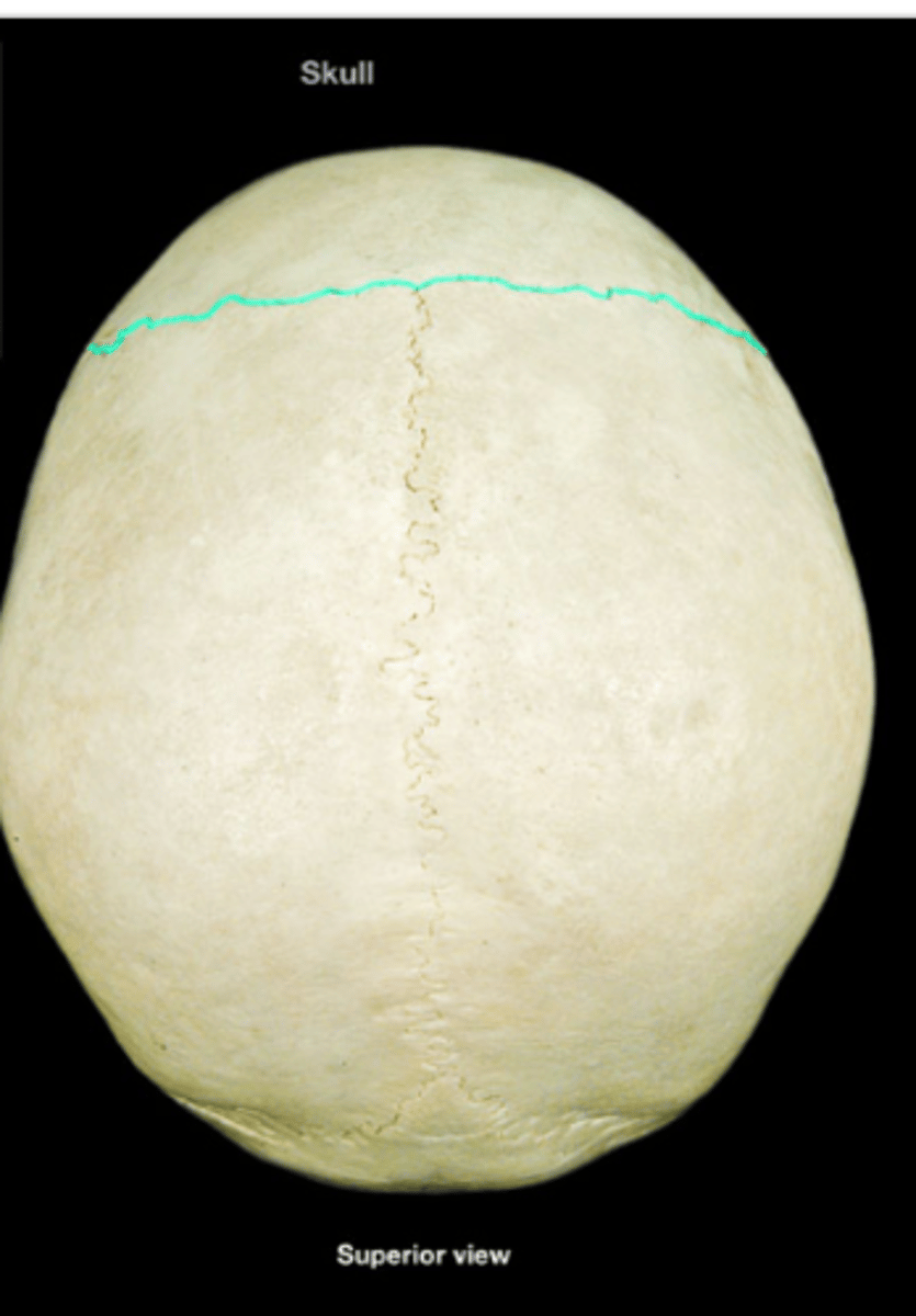 <p>Suture between frontal and parietal bones.</p>