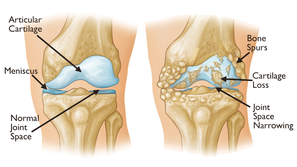 aka Degenerative Joint Disease (DJD) or "wear and tear Arthritis" caused trauma, repetitive overuse, or immobilization after injury wearing down the cartilage cushion covering bones in a joint; most common in bearing weight joints like hips, knees, neck, and lower back; results in bone rubbing against bone and crepitus (creaky joints). Seen mainly in elderly. Bone spurs grow in and try to freeze the damaged joint.
