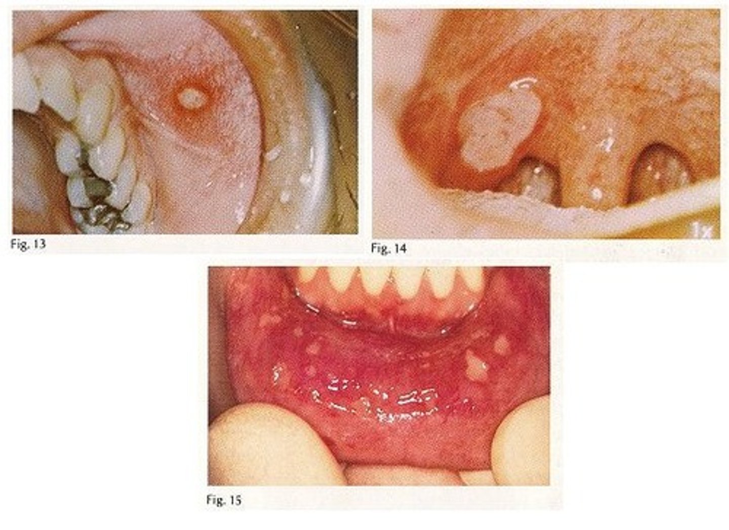 <p>Side Effects of Chemo:</p><p>What is stomatitis?</p>
