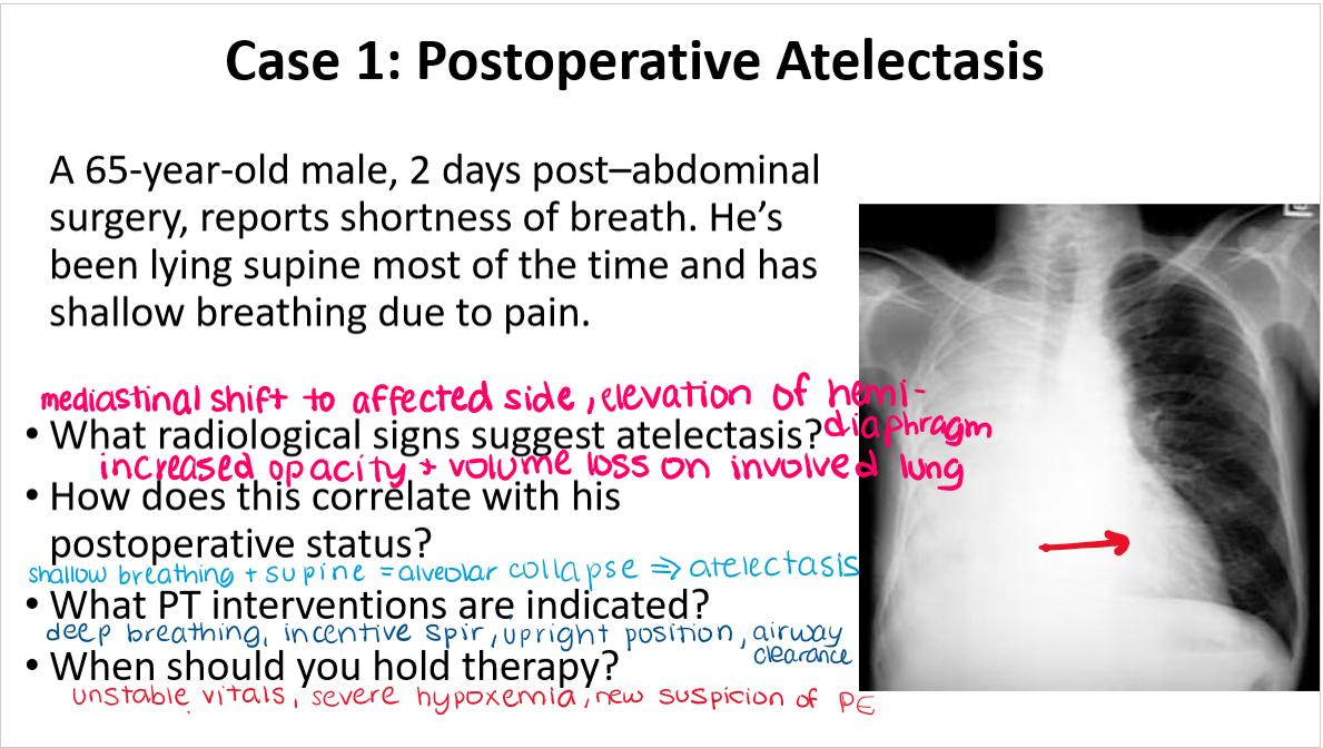 <p>atelectasis</p>
