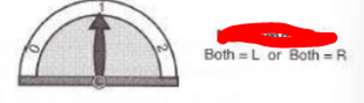 <p>occurs when the visual performance of the two eyes is no better, but no worse, than one</p>