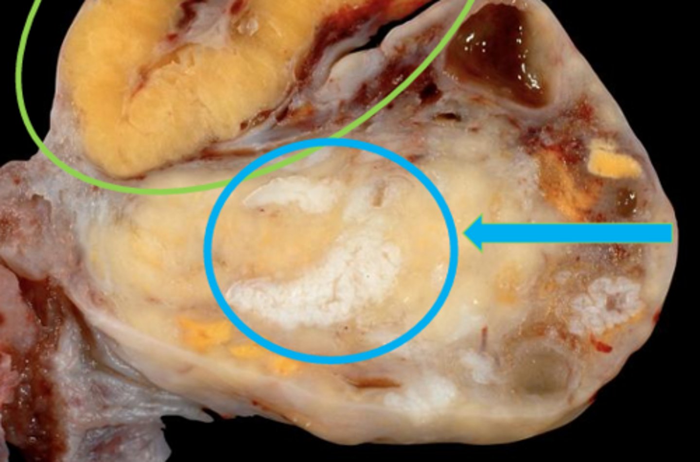 <p>the blue arrow is pointing to ____, which forms if fertilization DOES NOT occur (scar tissue!)</p>