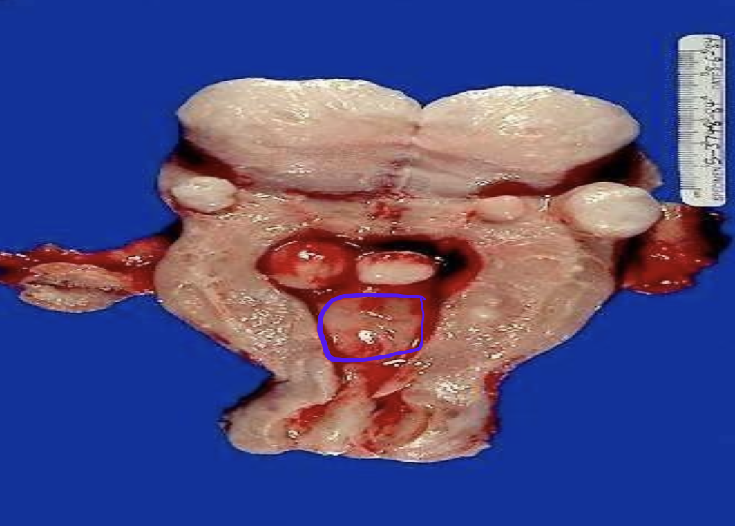 <p>Identify the <strong>organ</strong> and the <strong>diagnosis</strong> in this format: <em>diagnosis, organ</em></p>