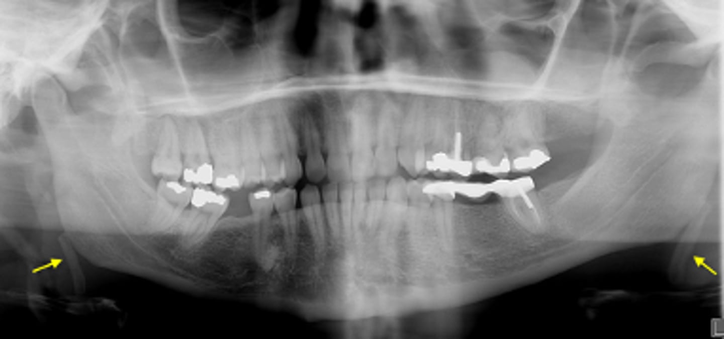 <p>ID the calcified abnormality:</p>