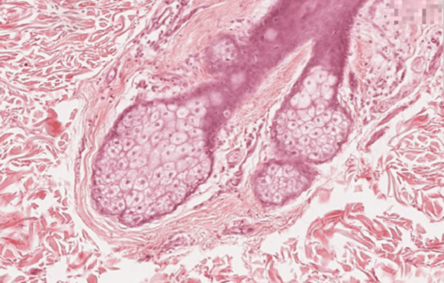 <p>Sebaceous</p>