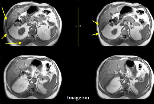 <p><span><strong>The yellow arrows in Image 201 display what type of MRI artifact?</strong></span></p>