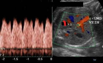 <ol><li><p>Which vessel is seen coming off the umbilical vein?</p></li><li><p>Does the doppler of this vessel look normal or abnormal?</p></li></ol><p></p>