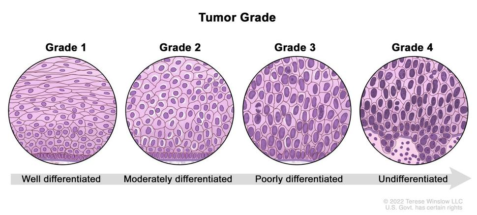 <p>What are the 3 tumor grades?</p>