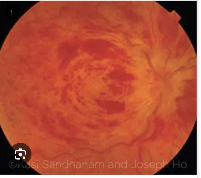 <p>37 y/o female presents to the ED for left eye vision loss that has occured over a couple minutes. On physical exam you note diffuse blood and thunder on the retina, What is your gameplan</p>