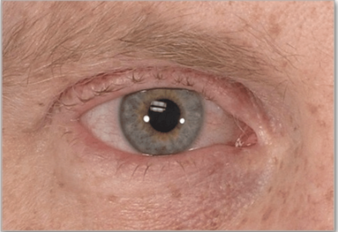 <p><u>Etio</u>: autoimmune inflammatory disorder, likely <strong>hereditary</strong></p><p><u>Risk Factors</u>: PMHx/FMHx Sjogren's syndrome </p><p><u>S&amp;S</u>: <strong>chronic bilateral dry eyes</strong> and mouth</p><p><u>Testing</u>: <strong>Schrirmer test </strong>x5 min</p><p><u>Tx</u>: <strong>OTC artificial tears</strong>, referral- optho and rheumatology, avoid dry outdoor areas w/ polllutants/irritants, no contacts</p>