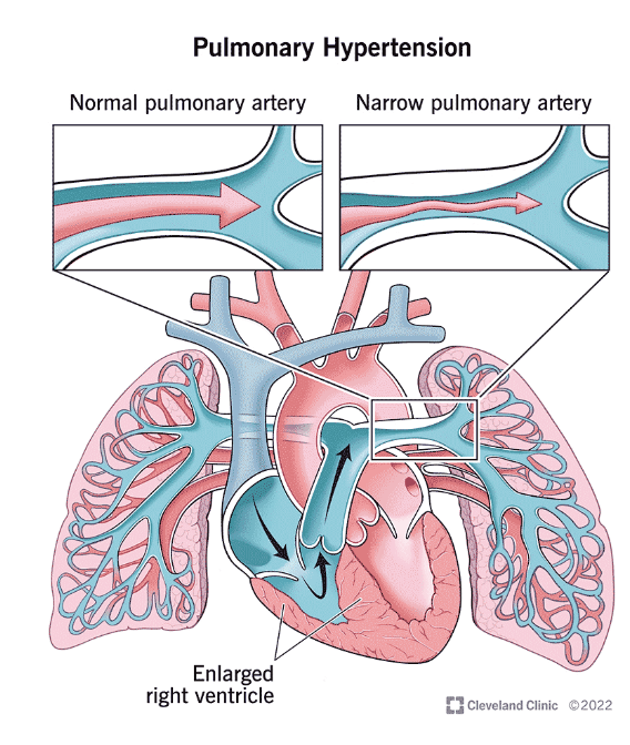 <p>Pulmonell hypertension omfattar flera sjukdomar. Vid pulmonell hypertension är trycket i lungkärlen högre än normalt, när trycket i <strong>A. pulmonalis överstiger 25 mmHg</strong>.</p><p>När trycket blir högt kompenserar högerkammaren genom att kontrahera kraftigare vilket på lång sikt ger <strong>högerkammarsvikt</strong>.&nbsp;</p><p>Det kan ge ospecifika symptom men ofta dyspné. Senare i förloppet kan hjärtsvikten ge symptom:</p><ul><li><p>Halsvenstas</p></li><li><p>Ödem</p></li><li><p>Illamående&nbsp;</p></li></ul>