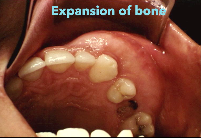 <p>What does fibrous dysplasia look like on a radiograph?</p>