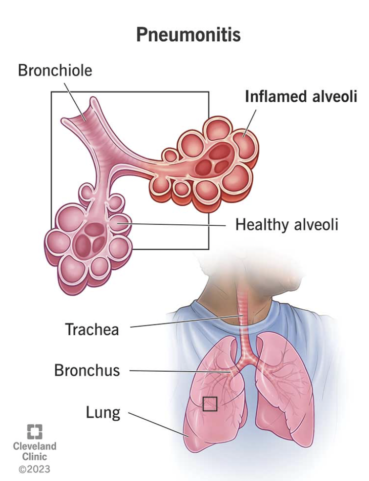 <p>Pulmonitis (pulmon-)</p>