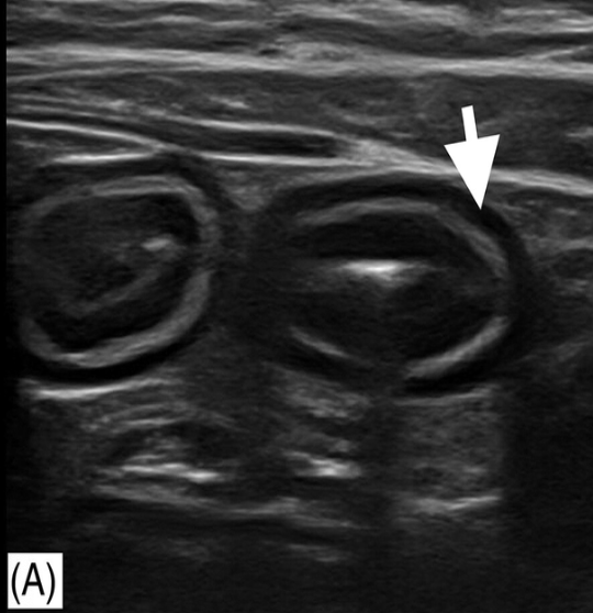 <p>U/S findings are highly variable and no distinguishing features (can use U/S to exclude other causes of chronic GI symptoms)</p><p>U/S of GI tract can be normal</p>