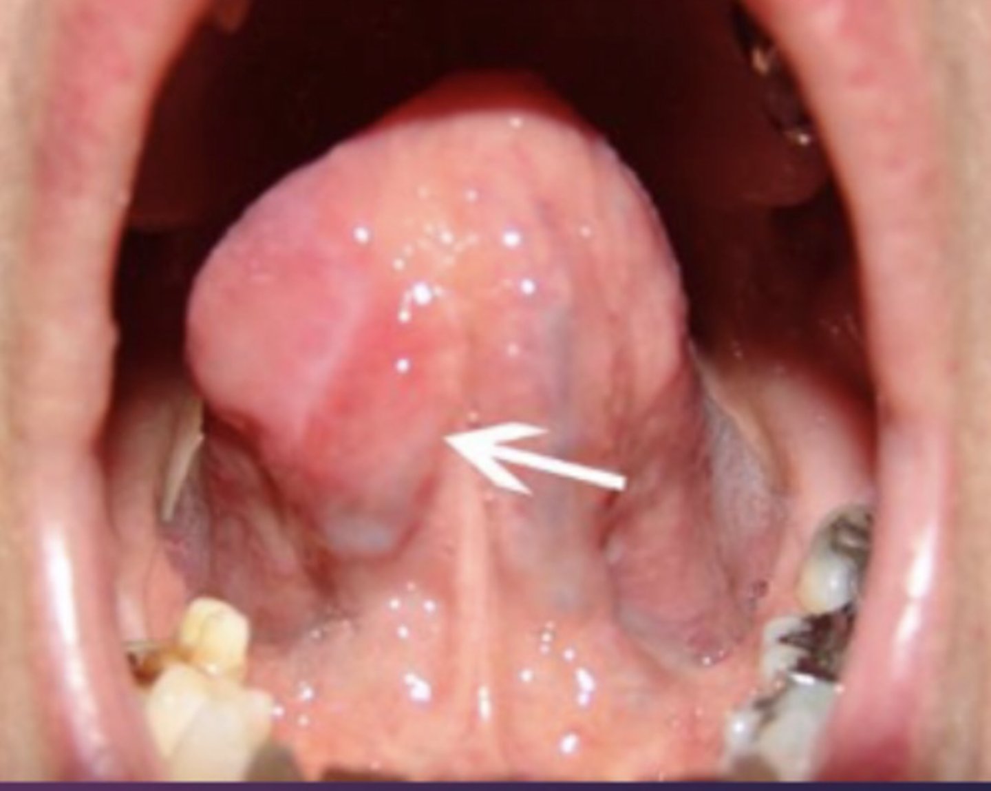 <p>Image of large mass on tongue: carcinoma</p><p>ranula</p><p>Neoplasm</p><p>Mucocele</p>