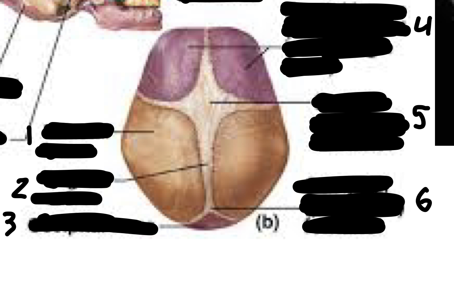 <ol><li><p>parietal bone</p></li><li><p>sagittal suture</p></li><li><p>occipital bone</p></li><li><p>frontal bone (not fused yet)</p></li><li><p>frontal (anterior) fontanel</p></li><li><p>occipital (posterior) fontanel</p></li></ol>