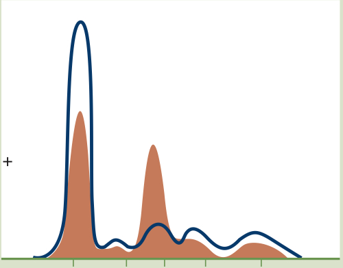 <p>- Loss of albumin<br>- Increased alpha 2 macroglobulin in α2 region since it is too large to be excreted, is retained<br>- <strong>Takeaway: Decrease of all fractions with the exception of α2</strong></p>