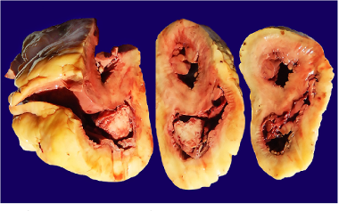 <p>What can cause endocarditis</p>