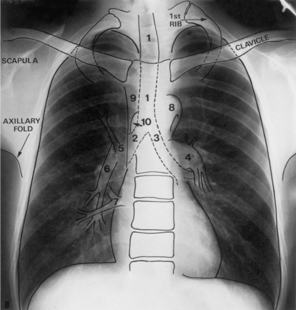 <p>CXR</p>
