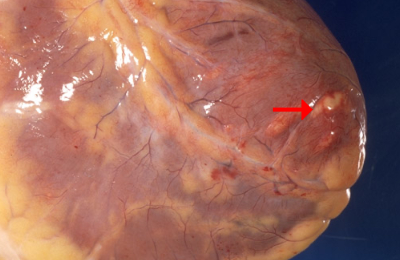 <ol><li><p>Identify morphologic pattern of acute inflammation</p></li><li><p>Possible adverse effects of myocarditis</p></li></ol><p></p>