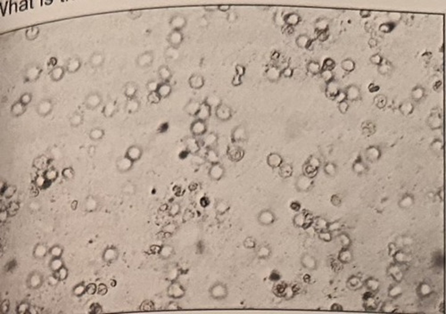 <p>What is the most likely diagnosis given the microscopic finding?</p><p>a. cystitis</p><p>b. pyelonephritis</p><p>c. glomerulonephritis</p><p>d. nephrotic syndrome</p>