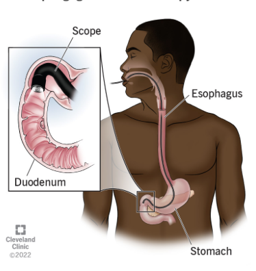 <p><span>Which imaging to assess the upper GI tract including esophagus, stomach, and duodenum looking for ulceration?</span></p>