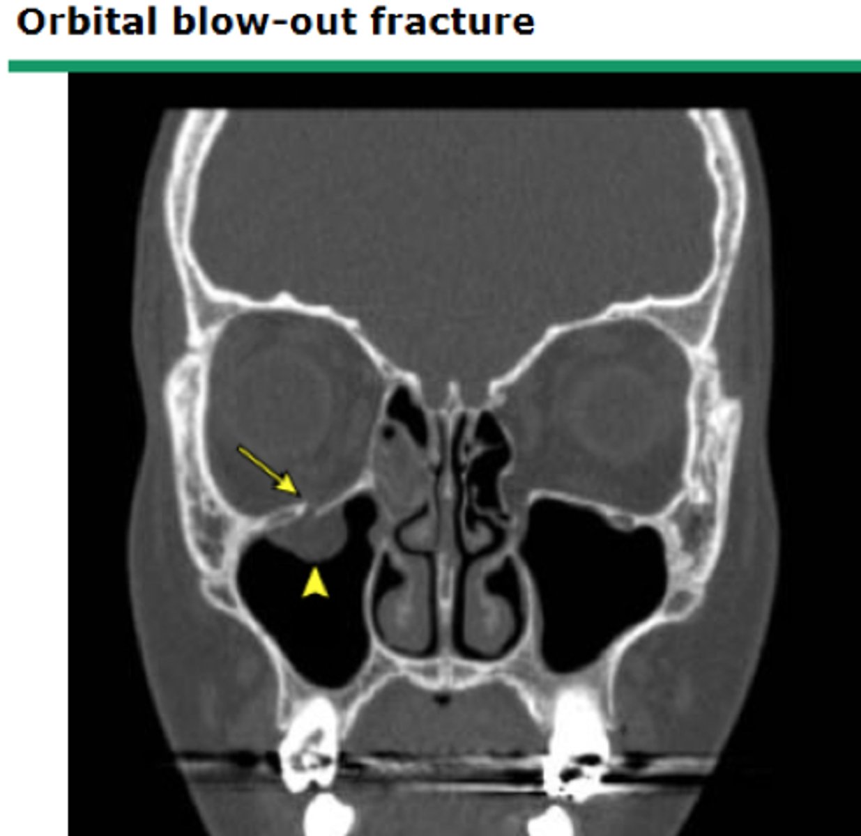 <p>Management includes an urgent surgical consult (maxillofacial, plastic, or ENT surgeon), ophthalmology consult (for evaluating visual acuity and potential eye dysfunction), prophylactic oral antibiotics (e.g., Augmentin), cold compresses, corticosteroids (to reduce swelling and help with diplopia), and patient education to avoid blowing the nose or sneezing (to prevent worsening of orbital emphysema).</p>