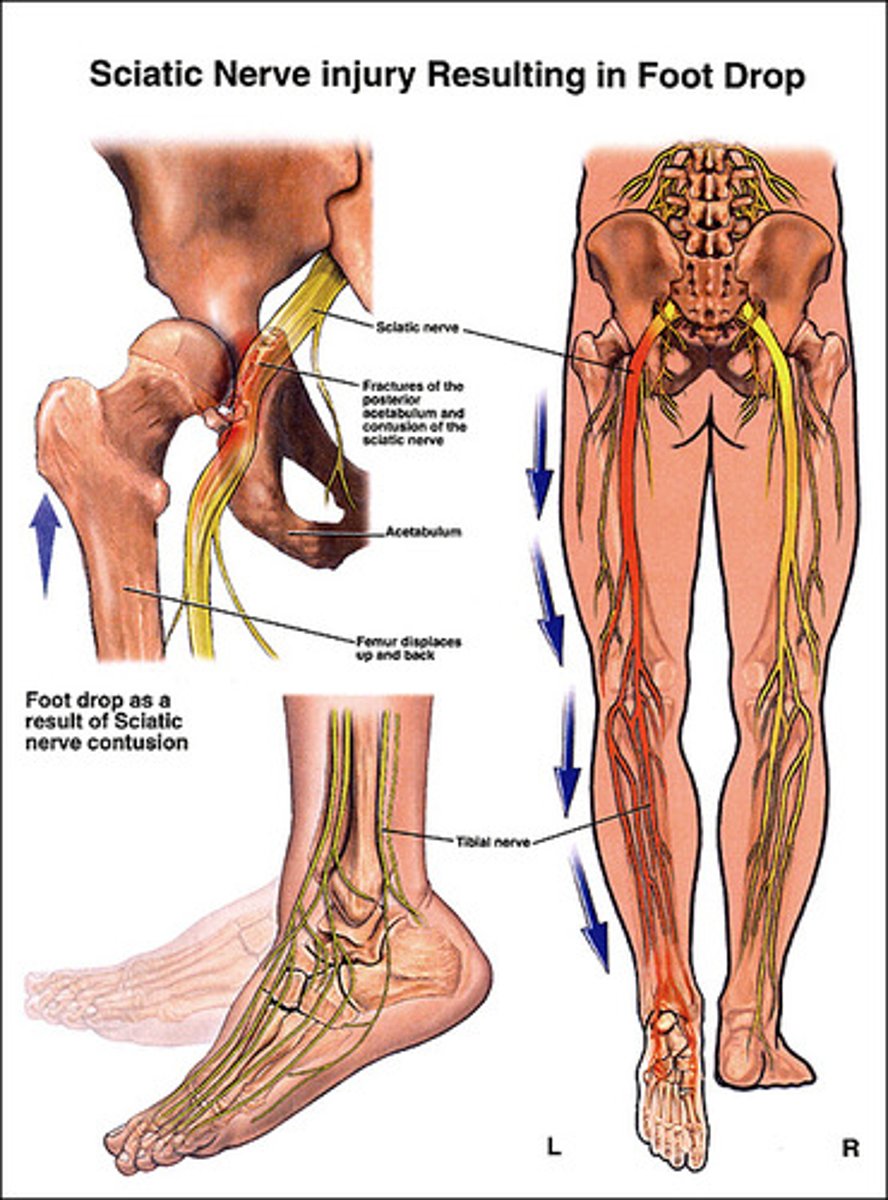 <p>1) Lower lumbar-sacral compression of spinal nerves or damage from fall, disc herniation, or badly placed injection into buttock can produce pain, numbness, and impair lower limbs</p><p>2) Sciatica: stabbing pain radiating over course of sciatic nerve</p><p>3) Transection (serving) leaves leg nearly useless (hamstrings paralyzed and all foot and ankle movement is lost)</p>